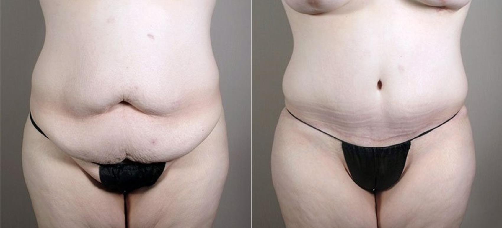 Liposuction Case 726 Before & After View #1 | Paramus, NJ | Parker Center for Plastic Surgery