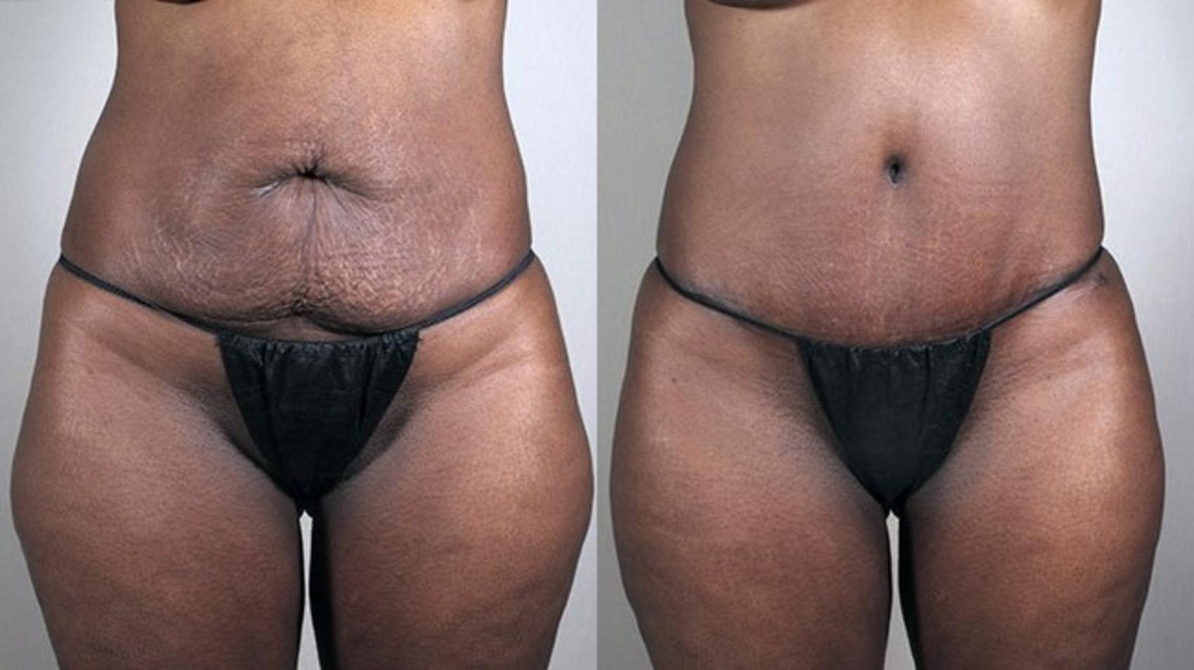 Tummy Tuck Case 727 Before & After View #1 | Paramus, NJ | Parker Center for Plastic Surgery