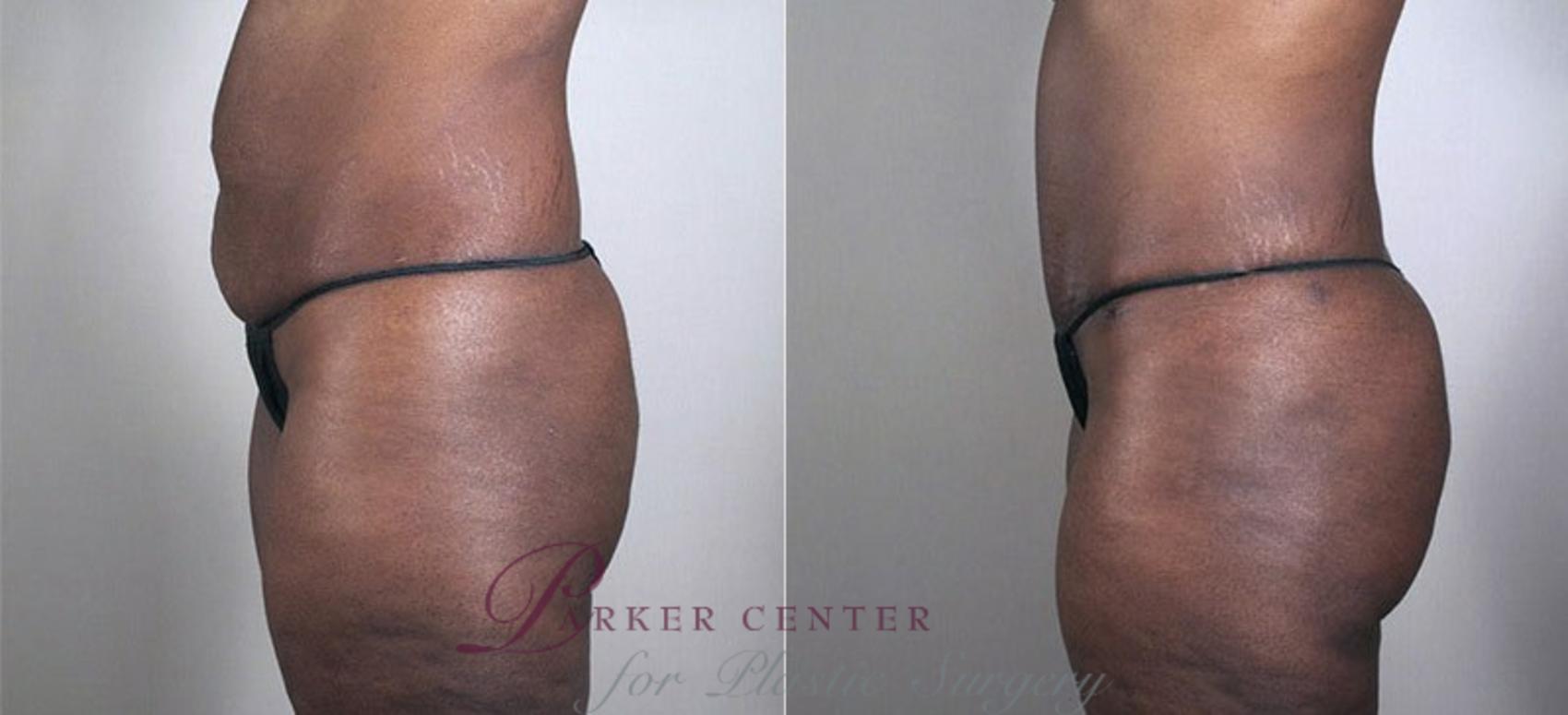 Tummy Tuck Case 727 Before & After View #2 | Paramus, NJ | Parker Center for Plastic Surgery