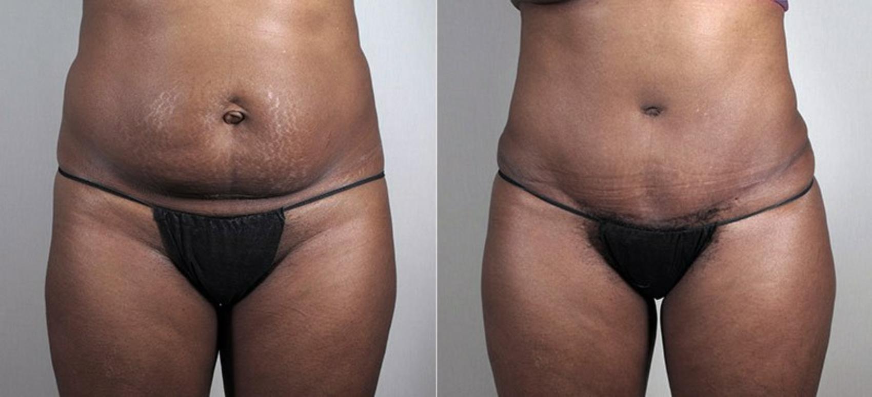 Tummy Tuck (Abdominoplasty) Before and After Pictures Case 66