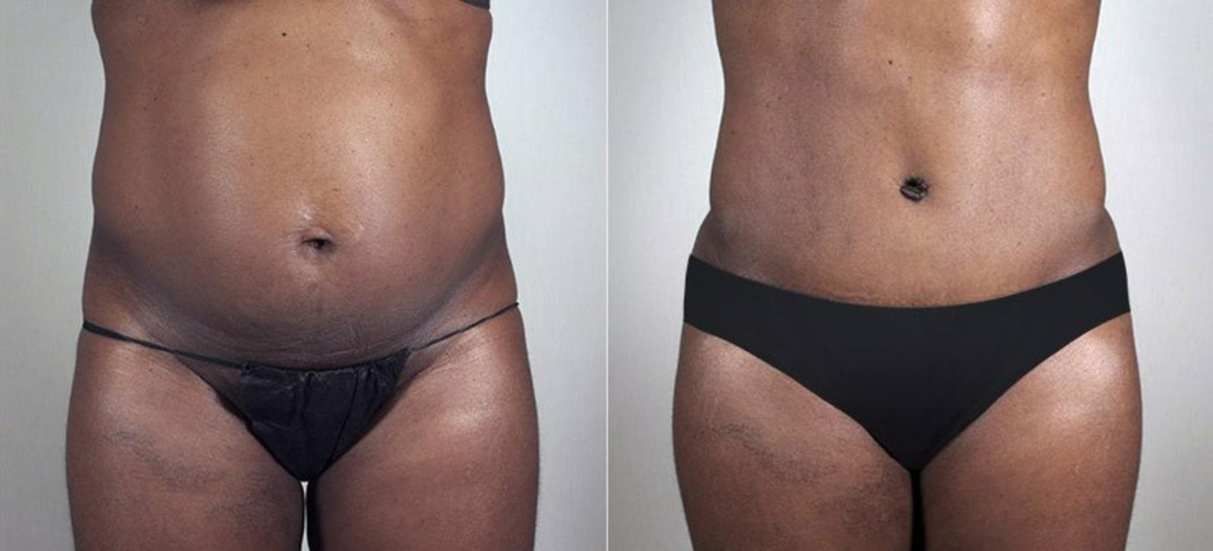 Tummy Tuck Case 729 Before & After View #1 | Paramus, NJ | Parker Center for Plastic Surgery