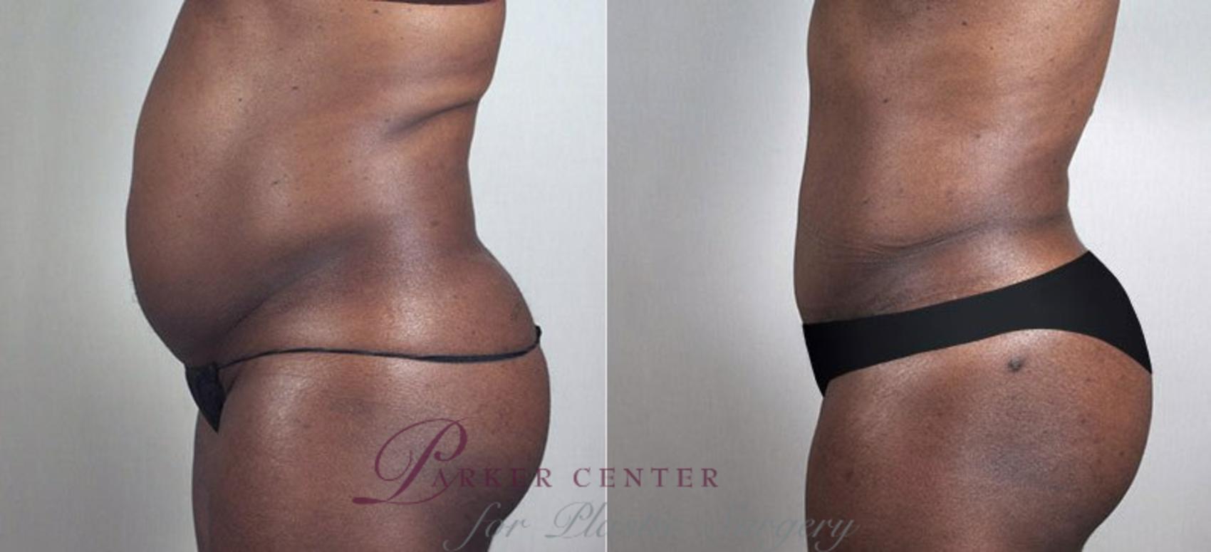 Liposuction Case 729 Before & After View #2 | Paramus, NJ | Parker Center for Plastic Surgery