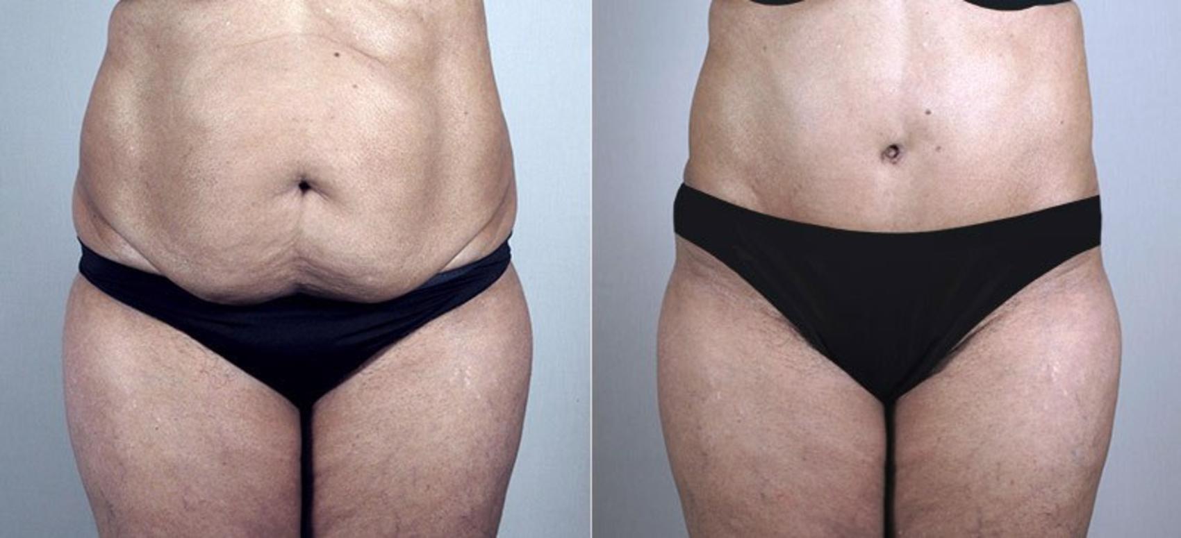 Tummy Tuck Case 731 Before & After View #1 | Paramus, NJ | Parker Center for Plastic Surgery