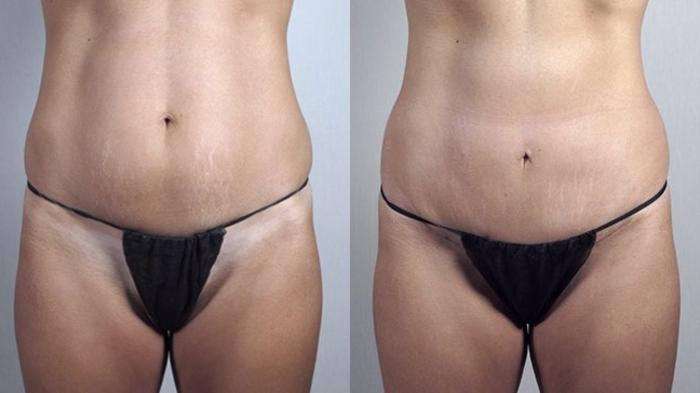 Tummy Tuck Case 732 Before & After Front | Paramus, New Jersey | Parker Center for Plastic Surgery