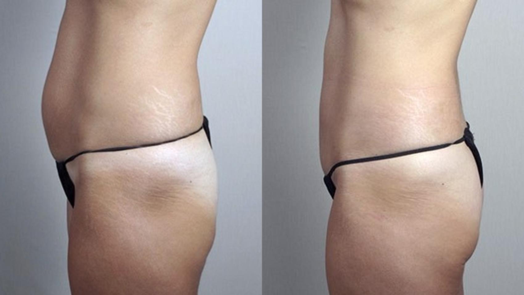 Tummy Tuck Case 732 Before & After Left Side | Paramus, New Jersey | Parker Center for Plastic Surgery