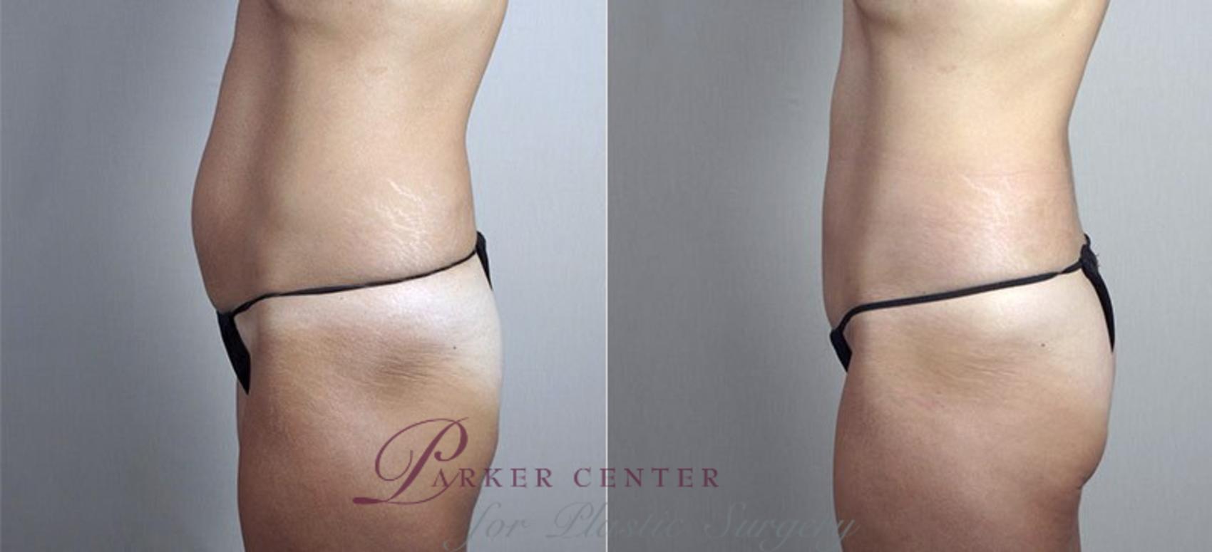 Tummy Tuck Case 732 Before & After View #1 | Paramus, New Jersey | Parker Center for Plastic Surgery