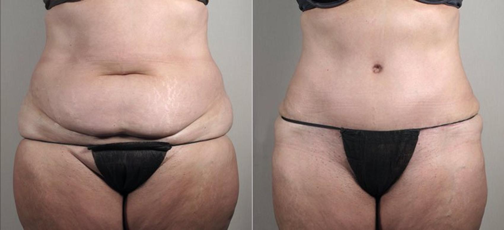 Tummy Tuck Case 733 Before & After View #1 | Paramus, NJ | Parker Center for Plastic Surgery