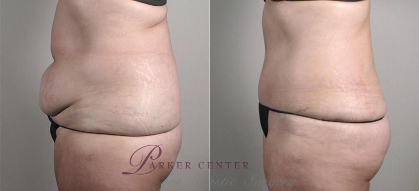 Tummy Tuck Case 733 Before & After View #2 | Paramus, New Jersey | Parker Center for Plastic Surgery