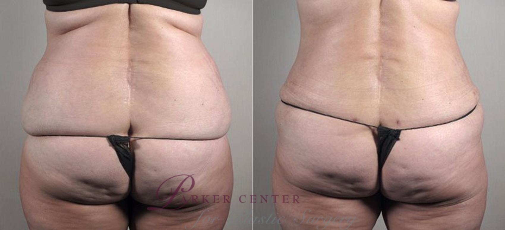 Tummy Tuck Case 733 Before & After View #3 | Paramus, New Jersey | Parker Center for Plastic Surgery