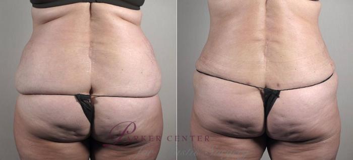 Liposuction Case 733 Before & After View #3 | Paramus, NJ | Parker Center for Plastic Surgery