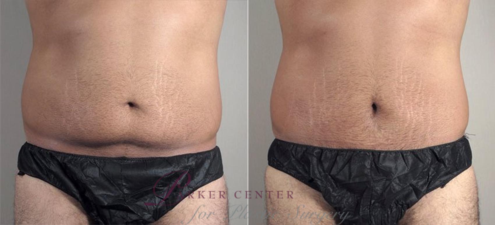Abdominoplasty Case 736 Before & After View #1 | Paramus, NJ | Parker Center for Plastic Surgery