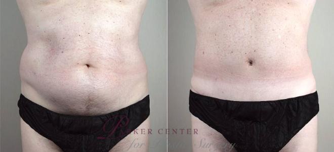 Tummy Tuck Case 738 Before & After View #1 | Paramus, NJ | Parker Center for Plastic Surgery