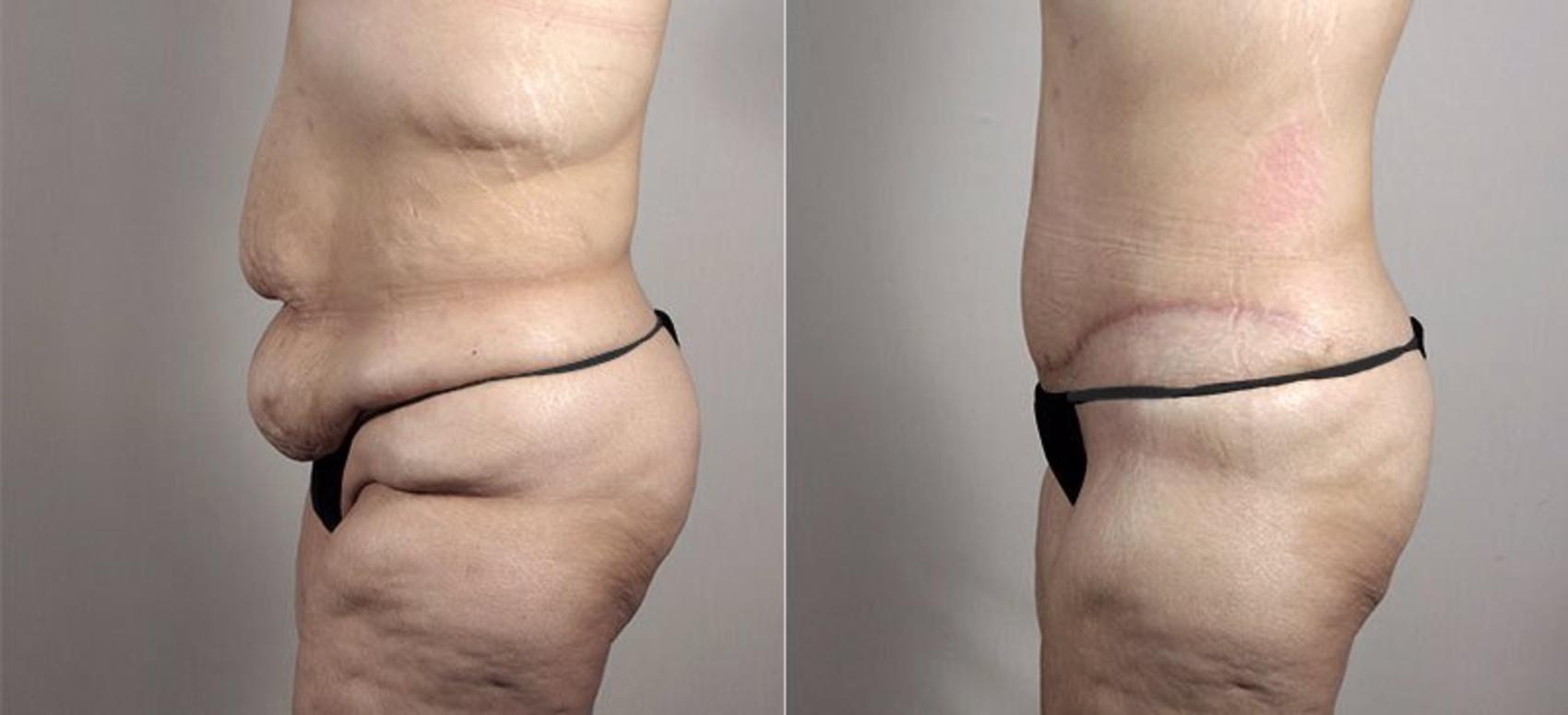 Tummy Tuck Case 739 Before & After View #2 | Paramus, NJ | Parker Center for Plastic Surgery