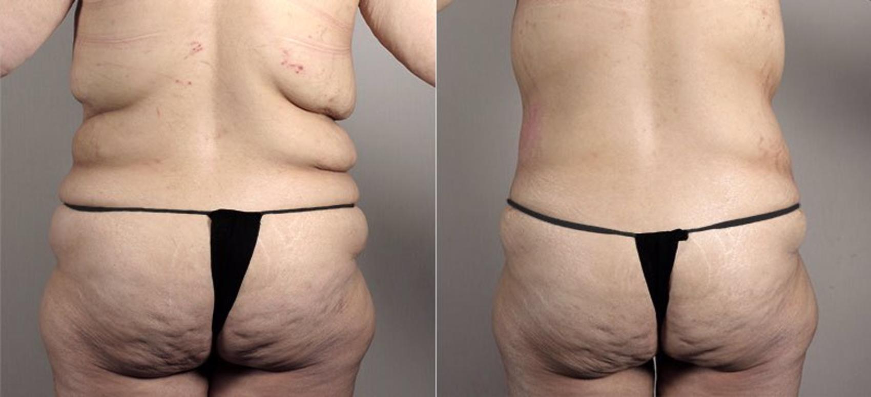Tummy Tuck Case 739 Before & After View #3 | Paramus, NJ | Parker Center for Plastic Surgery