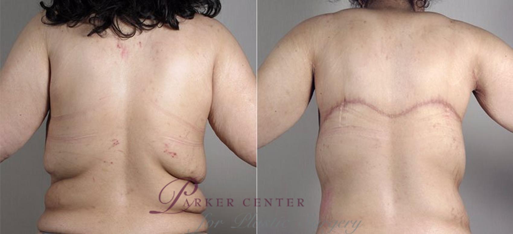 Tummy Tuck Case 739 Before & After View #4 | Paramus, NJ | Parker Center for Plastic Surgery