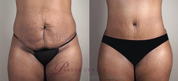 Tummy Tuck Before and After Photo Gallery, Paramus, NJ