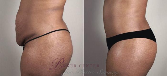 Liposuction Case 740 Before & After View #2 | Paramus, NJ | Parker Center for Plastic Surgery