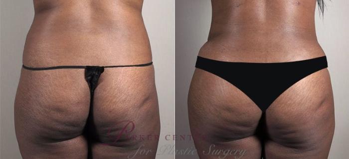Liposuction Case 740 Before & After View #3 | Paramus, NJ | Parker Center for Plastic Surgery