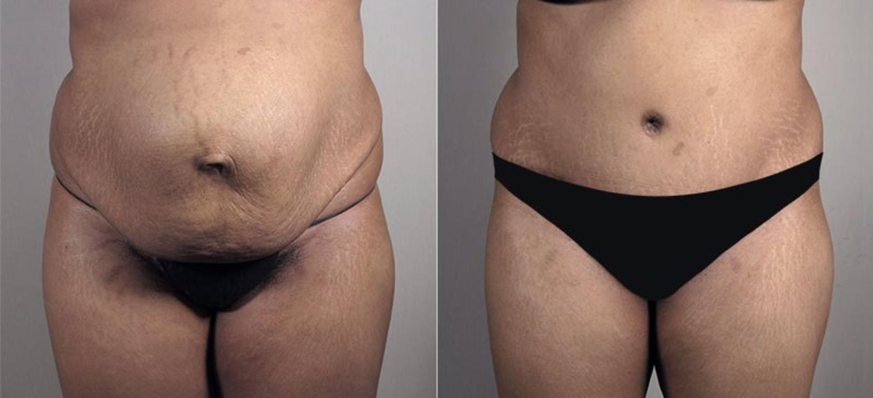 Tummy Tuck Case 742 Before & After View #1 | Paramus, New Jersey | Parker Center for Plastic Surgery