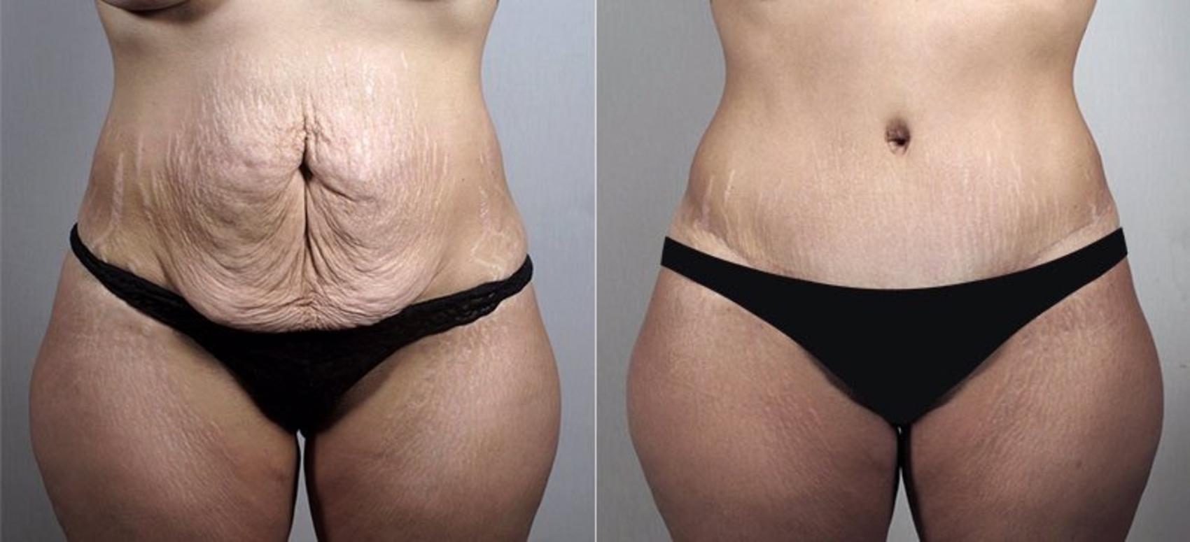 Tummy Tuck Before and After Pictures Case 745, Paramus, NJ