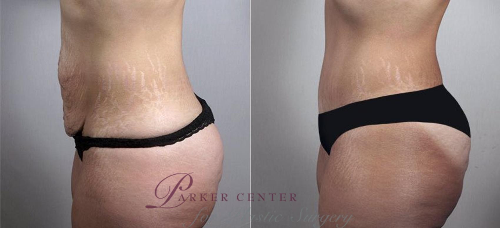 Tummy Tuck Case 745 Before & After View #2 | Paramus, New Jersey | Parker Center for Plastic Surgery