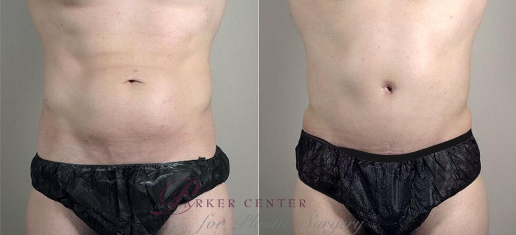 Abdominoplasty Case 746 Before & After View #1 | Paramus, NJ | Parker Center for Plastic Surgery