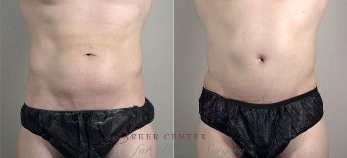 Liposuction Case 746 Before & After View #1 | Paramus, NJ | Parker Center for Plastic Surgery