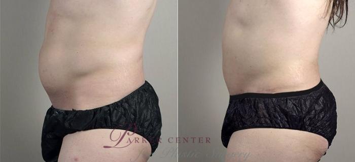 Liposuction Case 746 Before & After View #2 | Paramus, NJ | Parker Center for Plastic Surgery