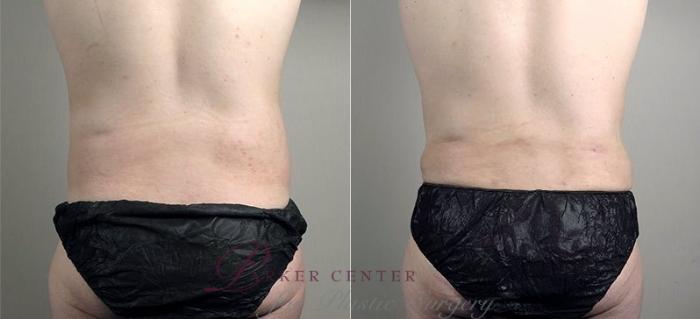 Liposuction Case 746 Before & After View #3 | Paramus, NJ | Parker Center for Plastic Surgery