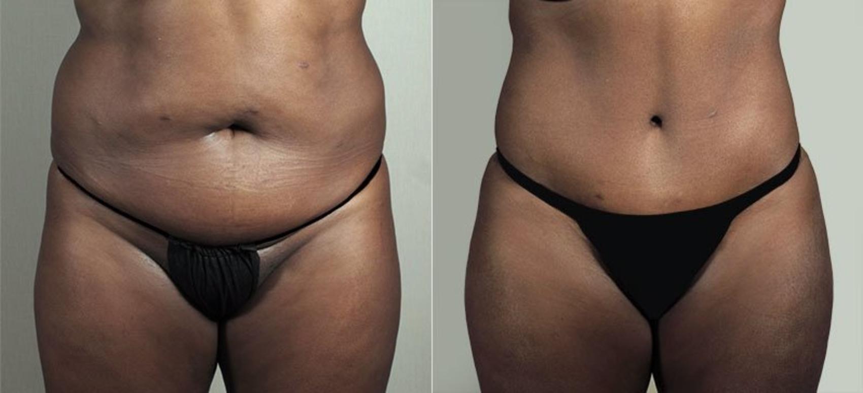 Abdominoplasty in Paramus, NJ, Tummy Tuck