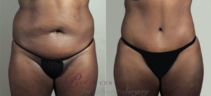Liposuction Case 747 Before & After View #1 | Paramus, NJ | Parker Center for Plastic Surgery