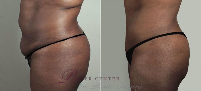 Tummy Tuck Case 747 Before & After View #2 | Paramus, NJ | Parker Center for Plastic Surgery