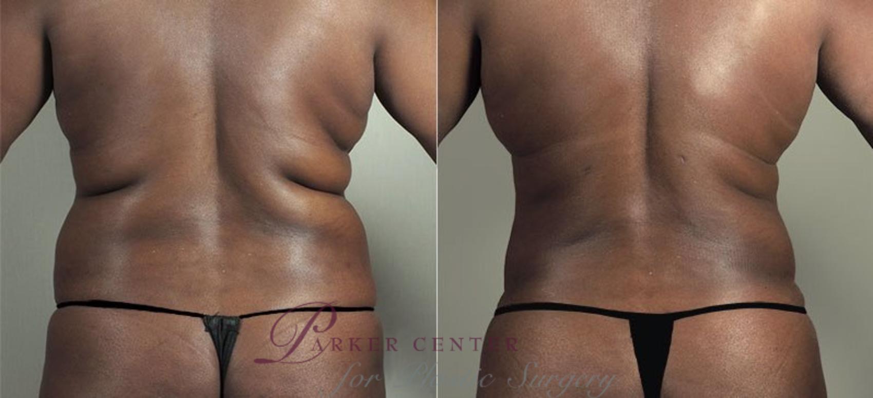 Tummy Tuck Case 747 Before & After View #3 | Paramus, New Jersey | Parker Center for Plastic Surgery