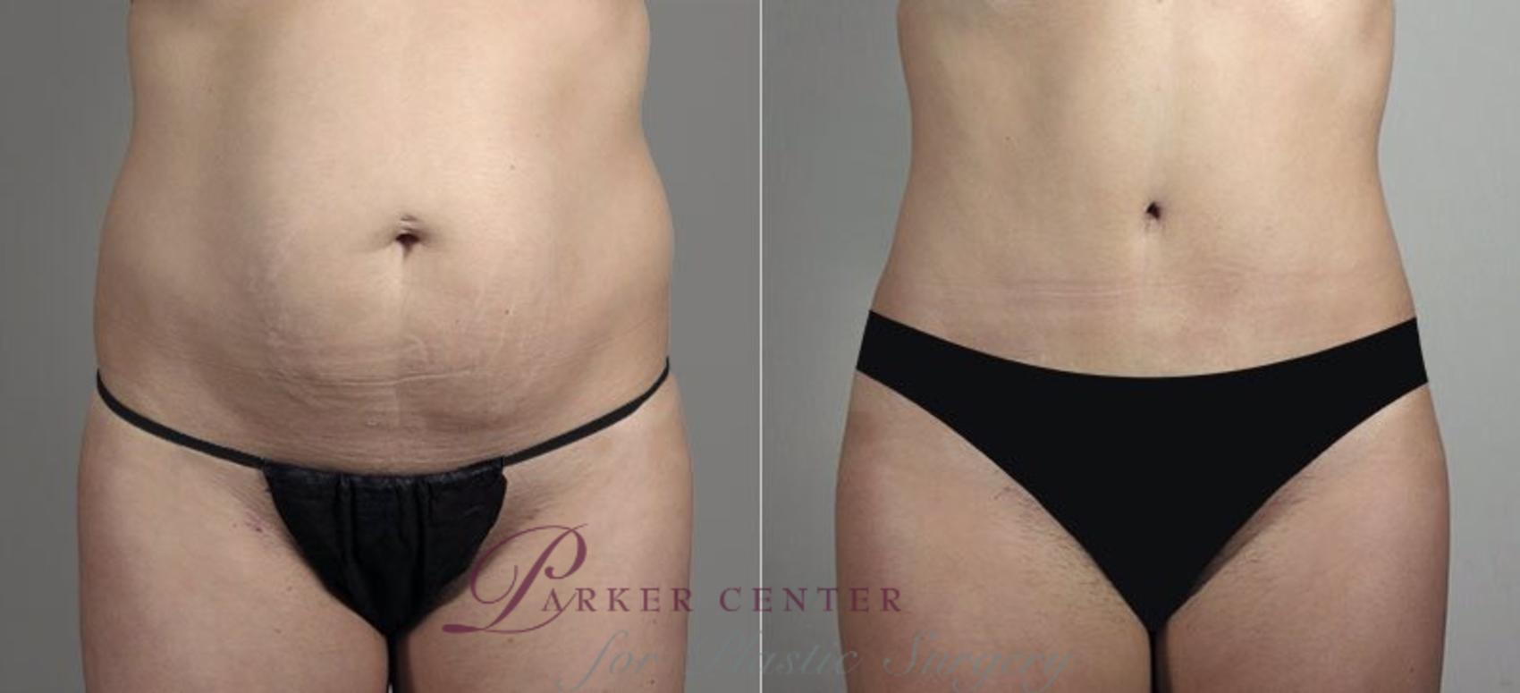 Liposuction Case 748 Before & After View #1 | Paramus, NJ | Parker Center for Plastic Surgery