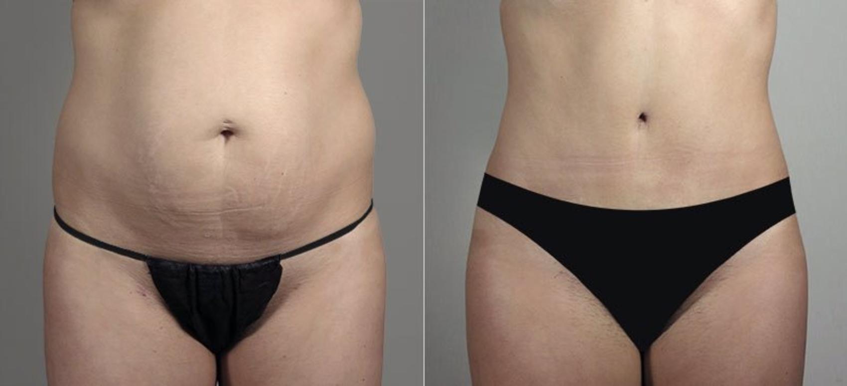 Liposuction Case 748 Before & After View #1 | Paramus, NJ | Parker Center for Plastic Surgery