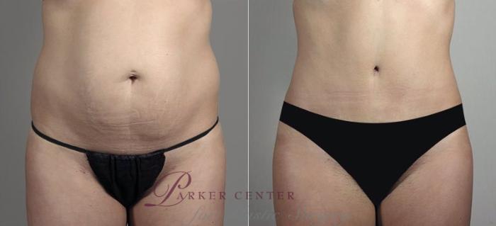 Liposuction Case 748 Before & After View #1 | Paramus, NJ | Parker Center for Plastic Surgery