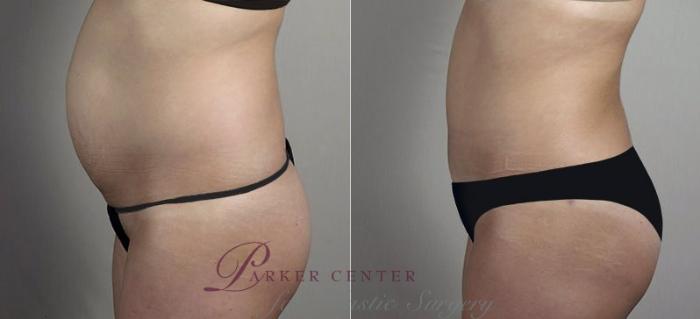 Liposuction Case 748 Before & After View #2 | Paramus, NJ | Parker Center for Plastic Surgery