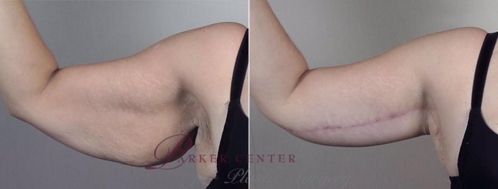 Upper Arm Rejuvenation Case 749 Before & After View #4 | Paramus, NJ | Parker Center for Plastic Surgery