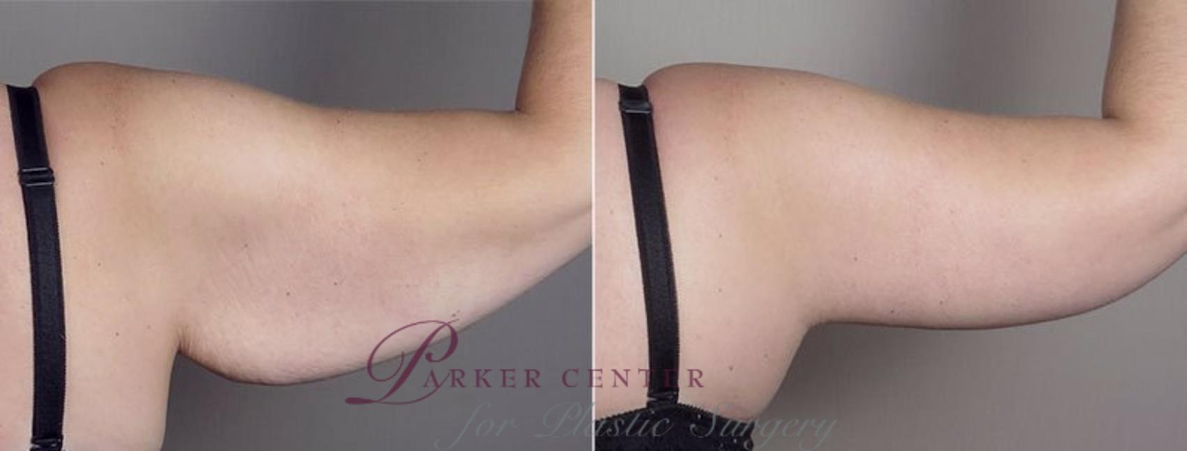 Upper Arm Rejuvenation Case 749 Before & After View #7 | Paramus, NJ | Parker Center for Plastic Surgery