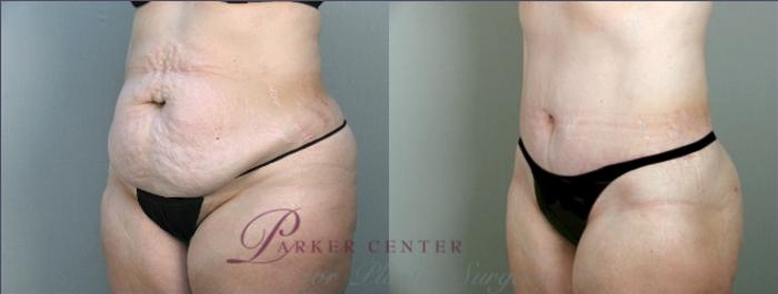 Liposuction Case 912 Before & After View #5 | Paramus, NJ | Parker Center for Plastic Surgery