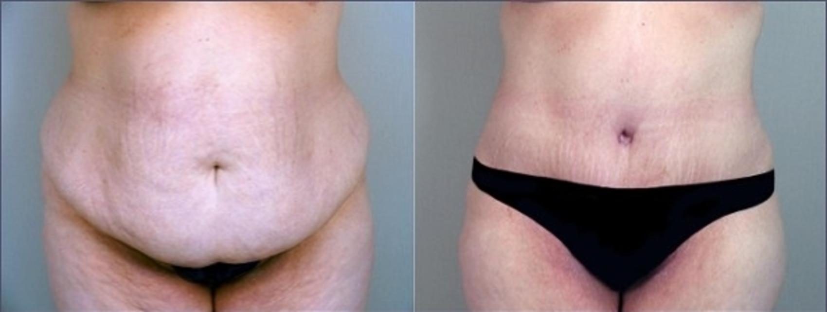 Liposuction Case 919 Before & After View #1 | Paramus, NJ | Parker Center for Plastic Surgery