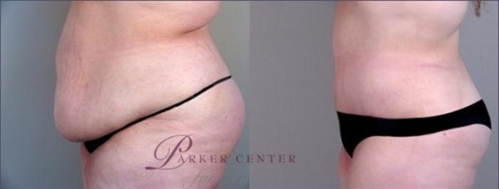 Liposuction Case 919 Before & After View #2 | Paramus, NJ | Parker Center for Plastic Surgery