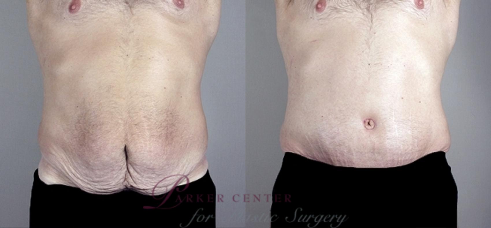 Liposuction Case 949 Before & After View #5 | Paramus, NJ | Parker Center for Plastic Surgery