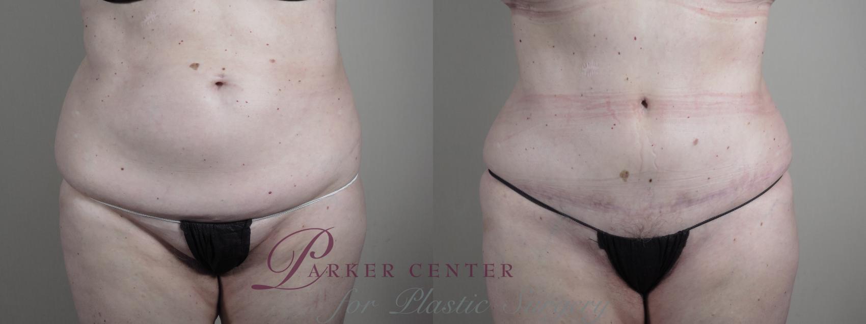 Tummy Tuck Case 987 Before & After Front | Paramus, NJ | Parker Center for Plastic Surgery