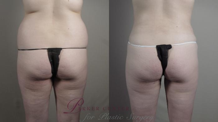 Liposuction Case 990 Before & After Back | Paramus, NJ | Parker Center for Plastic Surgery