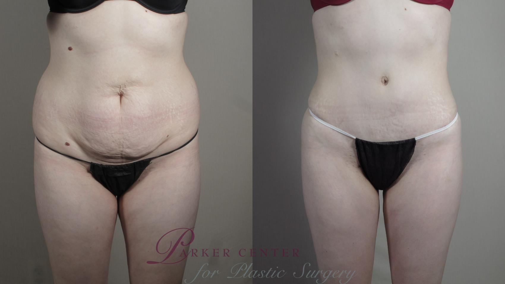Liposuction Case 990 Before & After Front | Paramus, NJ | Parker Center for Plastic Surgery