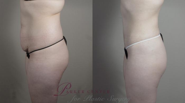 Tummy Tuck Case 990 Before & After Right Side | Paramus, NJ | Parker Center for Plastic Surgery
