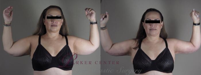 Body Case 1287 Before & After Front | Paramus, NJ | Parker Center for Plastic Surgery