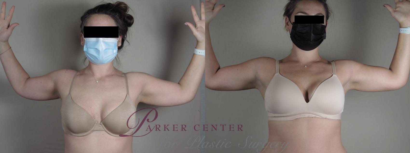 CoolSculpting® Case 1095 Before & After Front | Paramus, NJ | Parker Center for Plastic Surgery