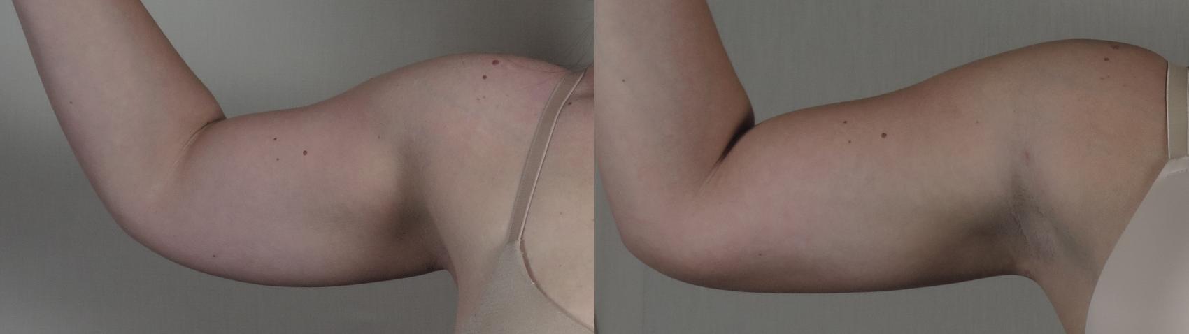 Upper Arm Rejuvenation Case 1095 Before & After Front | Paramus, New Jersey | Parker Center for Plastic Surgery